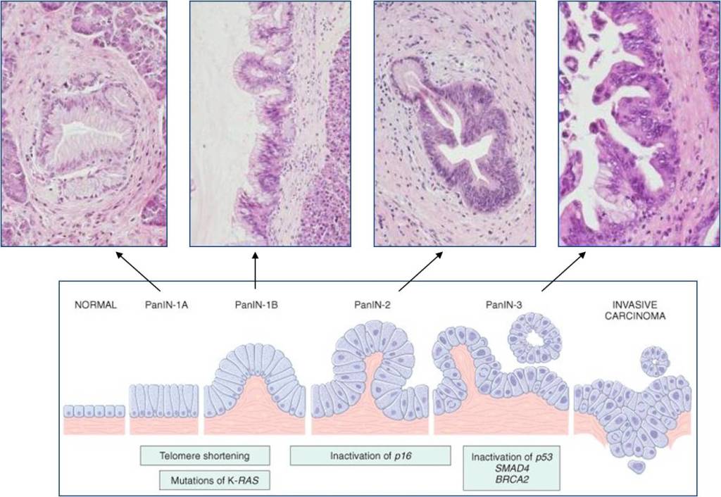 Preneoplastic lesions 2